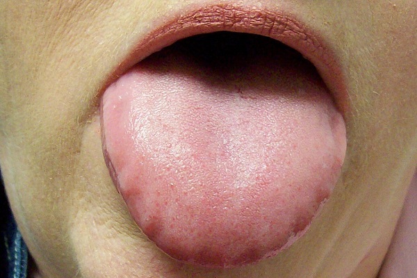 تشخیص بیماری از روی زبان